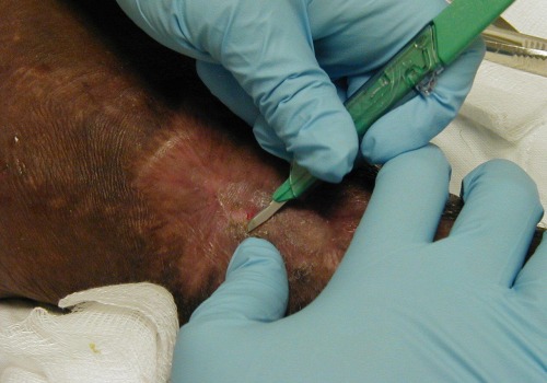 Expert-Recommended Techniques for Removing Slough From Wounds